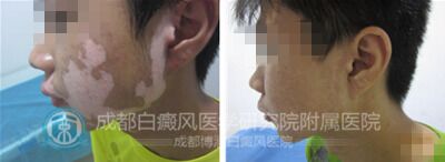 白癜风如何进行规范化诊疗?